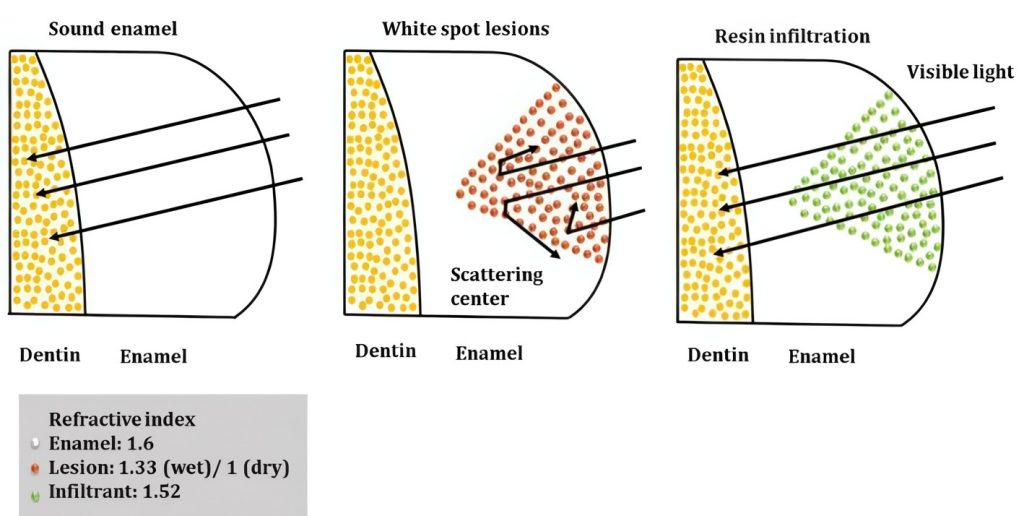 "Schematic of white spot lesions in enamel and resin infiltration treatment, with golden-brown, orange, and green areas representing healthy enamel, lesions, and resin, respectively."